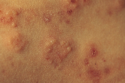 coeliac disease rash photos