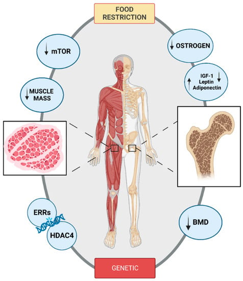 anorexia nervosa