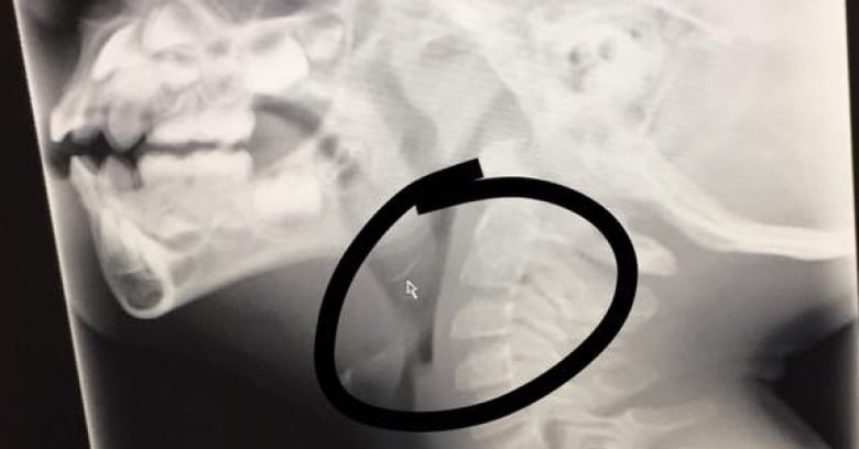 toothbrush bristle stuck in throat