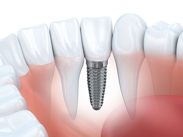 dental implants services maple ridge