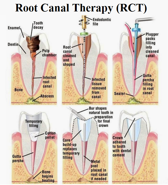 medicated filling vs root canal