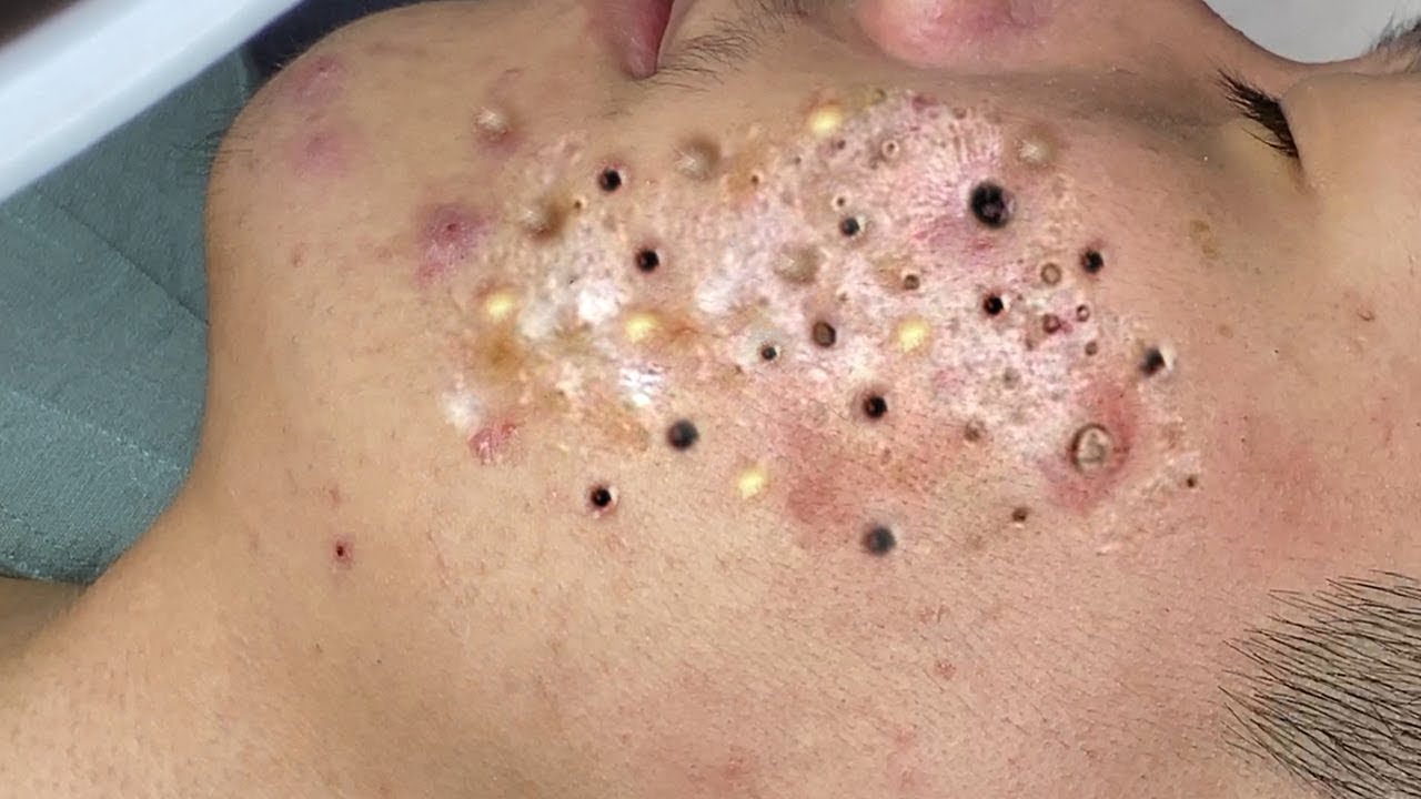 new blackheads today