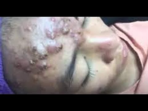 newest blackhead removal videos 2023