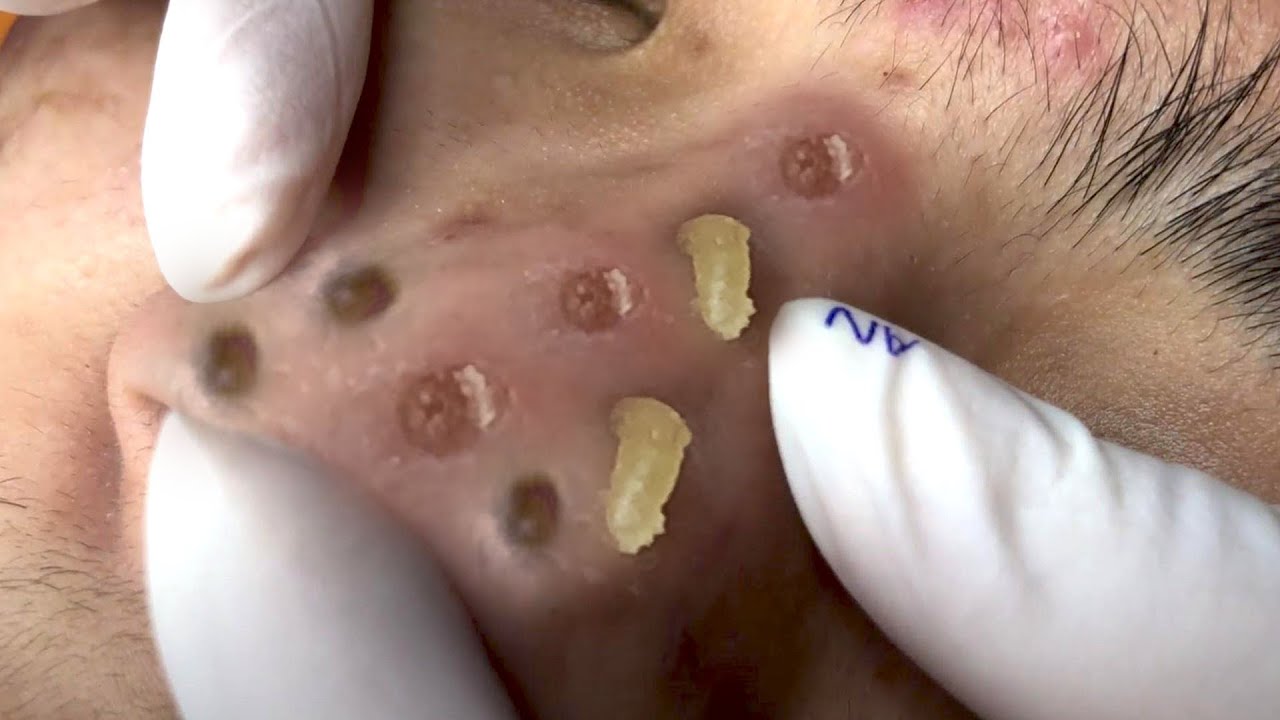 huge blackheads popped