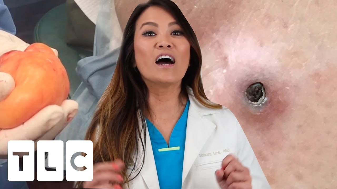 dr pimple popper biggest blackhead