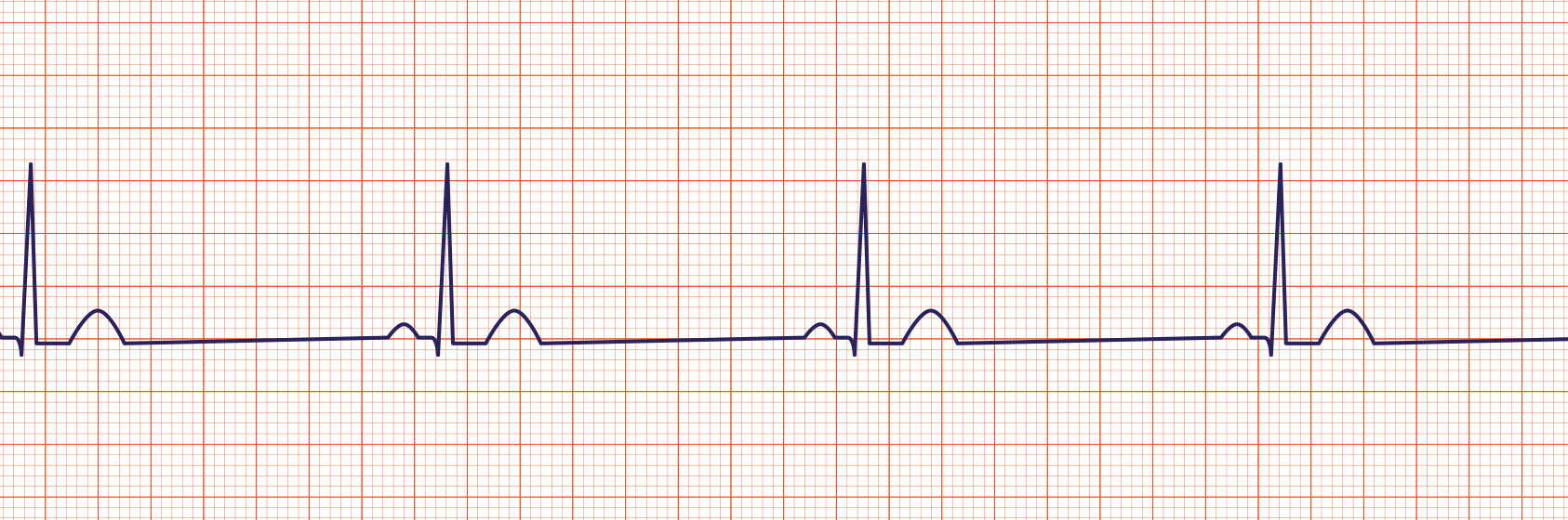 acls ecg rhythms