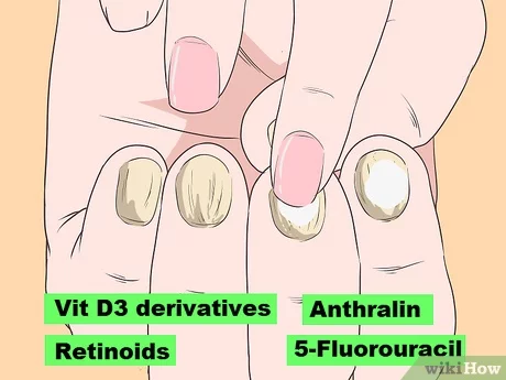 pintar uñas con psoriasis