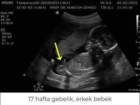 erkek bebek ultrasonda nasil durur