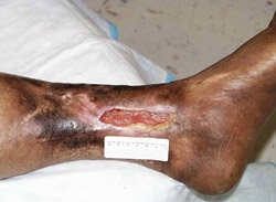 icd 10 venous stasis ulcer right lower leg