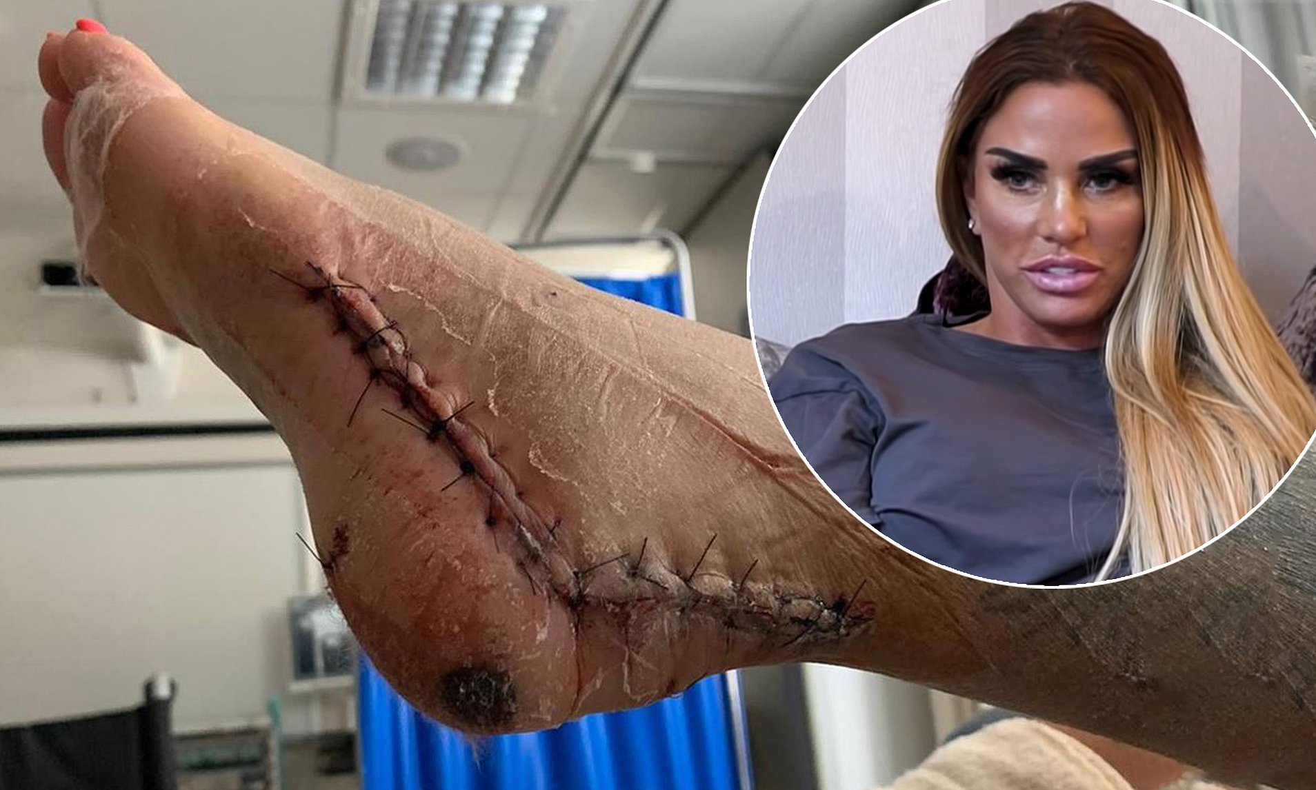 katie price broken feet