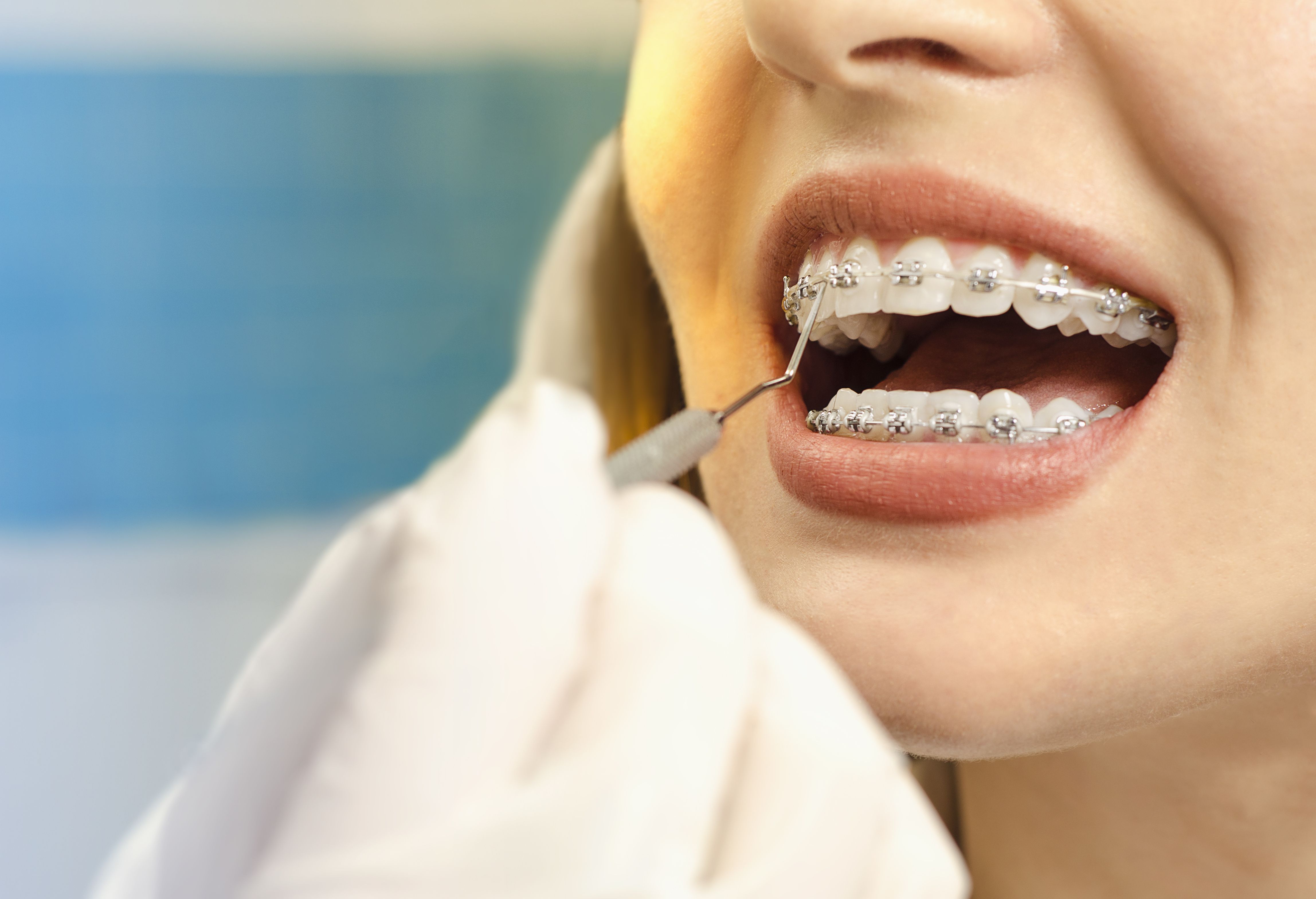 teeth braces images