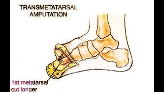 transmetatarsal meaning