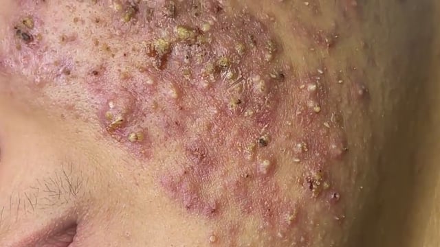 severe cystic acne popping