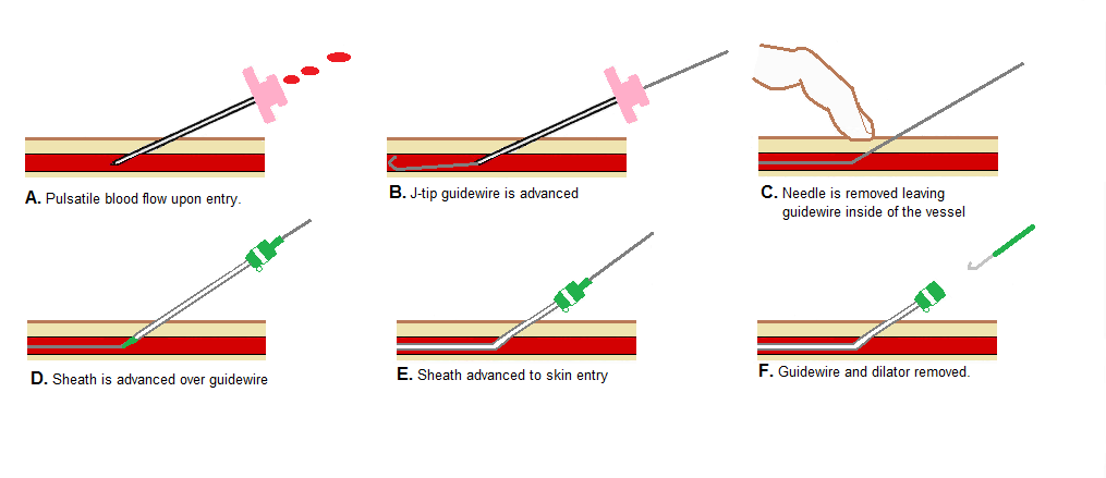 flipping the arterial vascular access needle