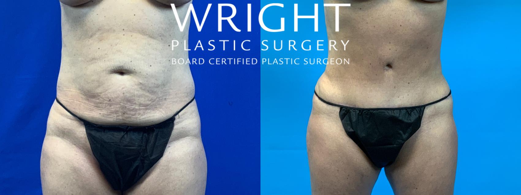 tummy tuck arkansas