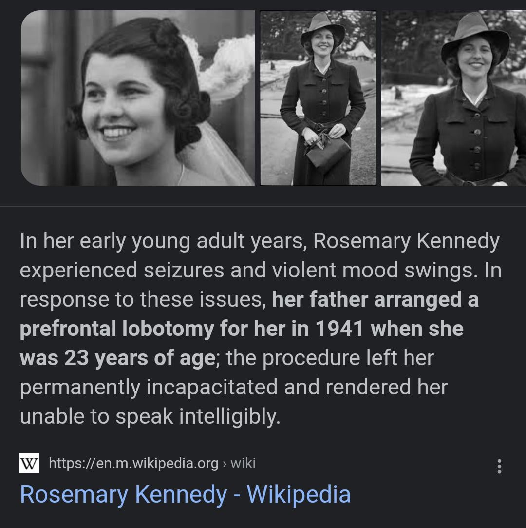 jfk sister lobotomy before and after