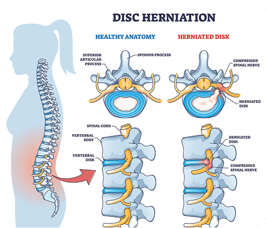 slippedisc