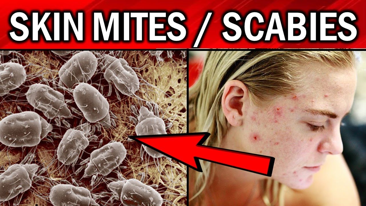 does vinegar kill scabies