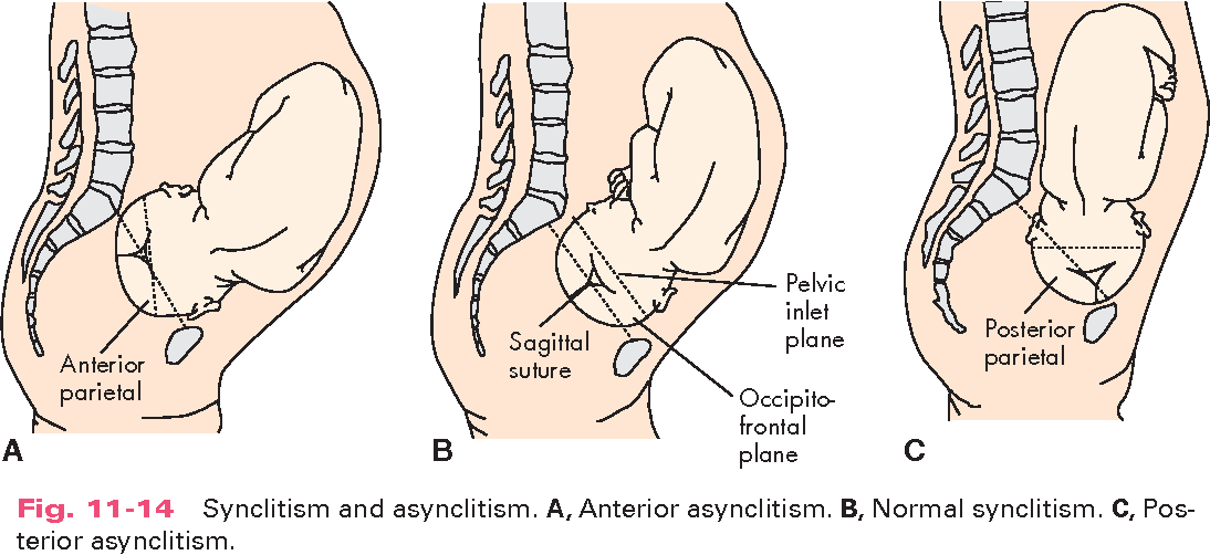 asynclitism meaning