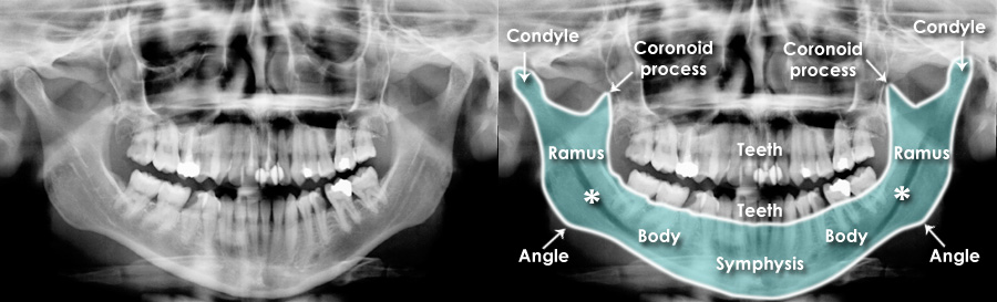 mandible anatomy radiology