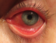 conjuntivitis en aleman