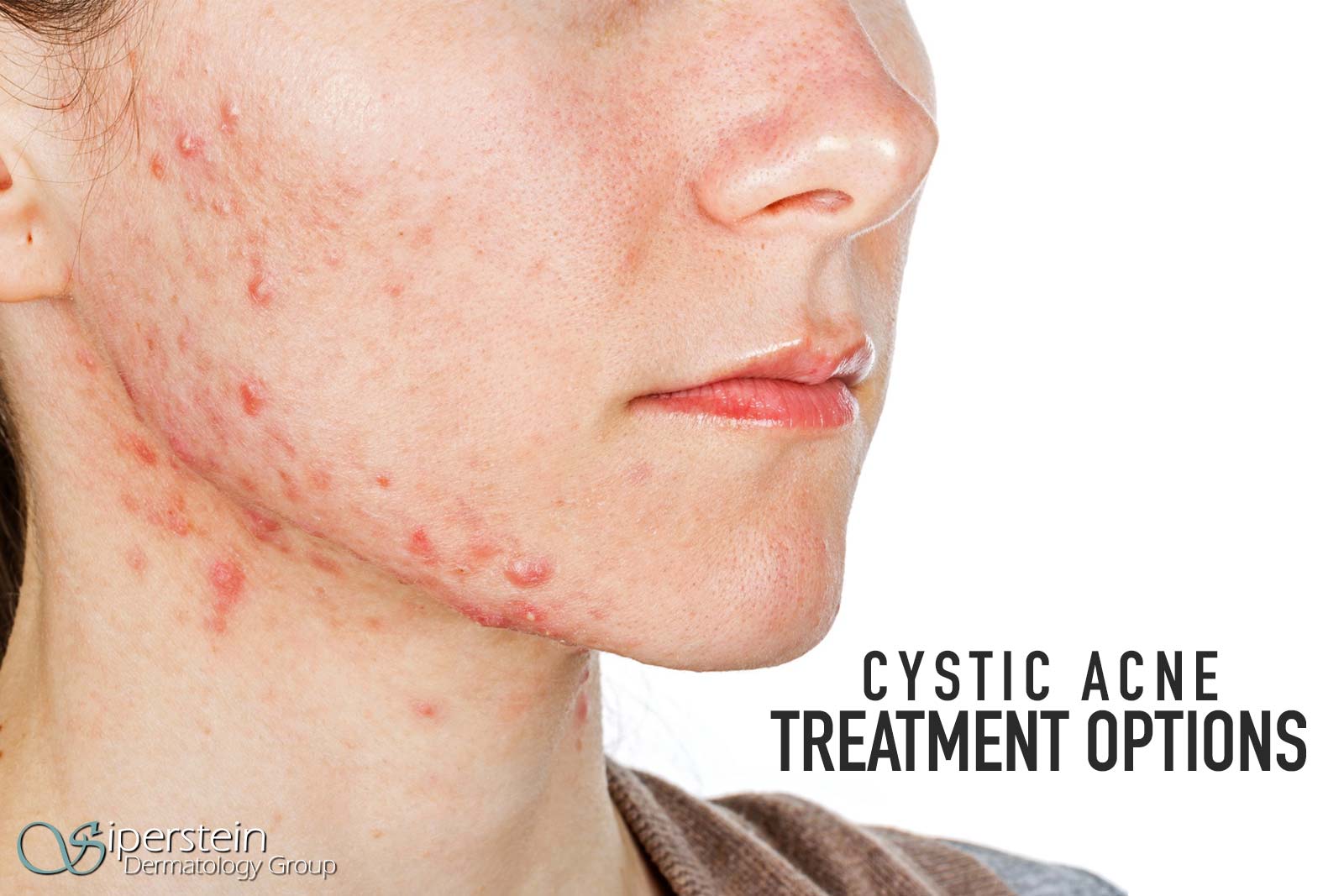 popping cystic acne