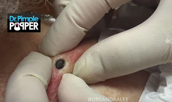 new dr pimple popper blackheads