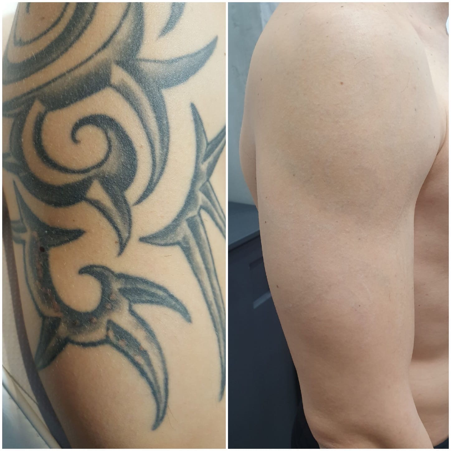 tattoo removal madrid