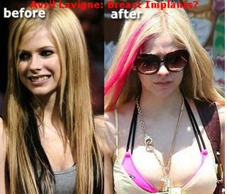 avril lavigne boob job