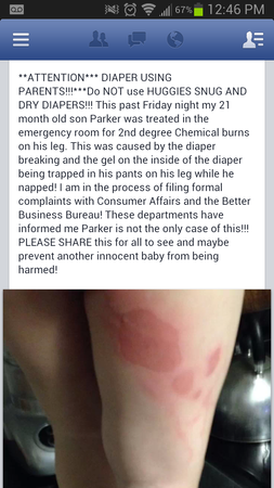 chemical burn from huggies