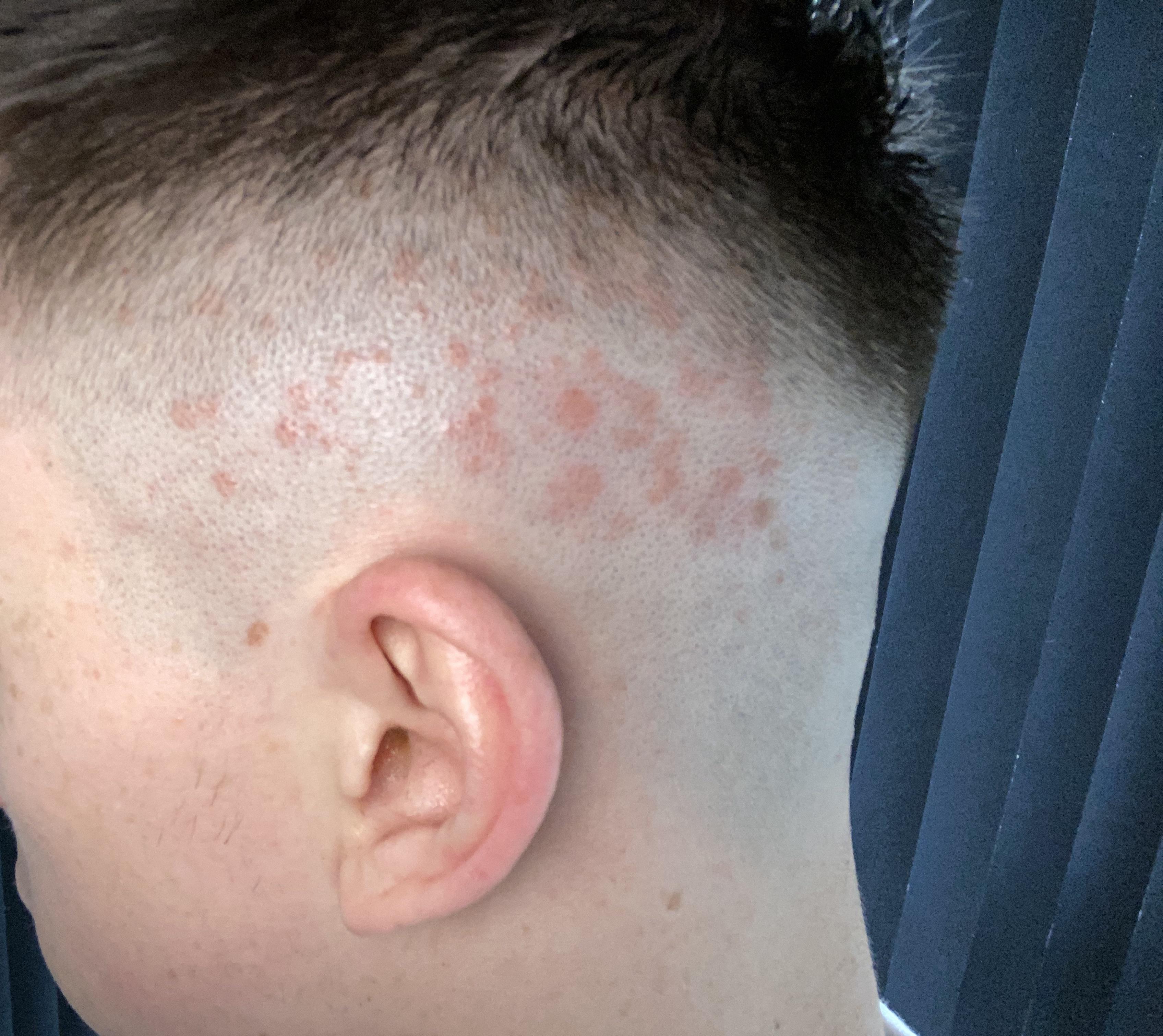 rash from barber shop