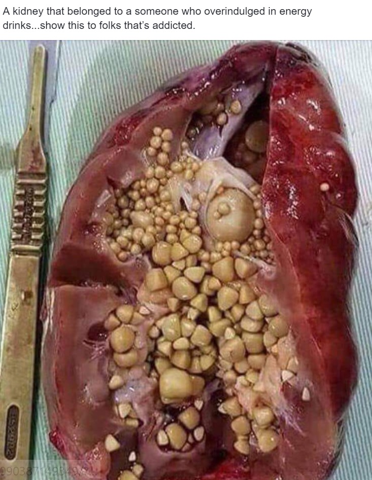 monster energy kidney stones