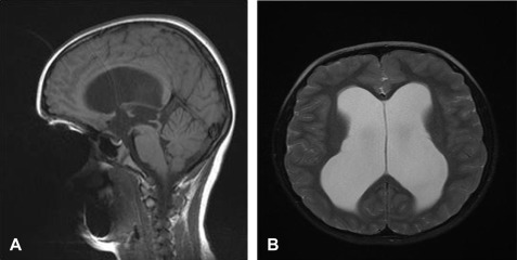 cerebral aqueduct stenosis