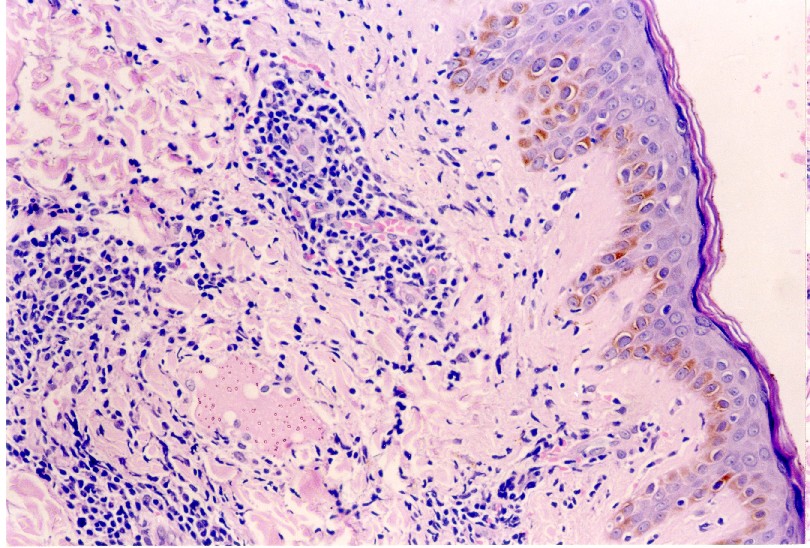 lymphocytic infiltration