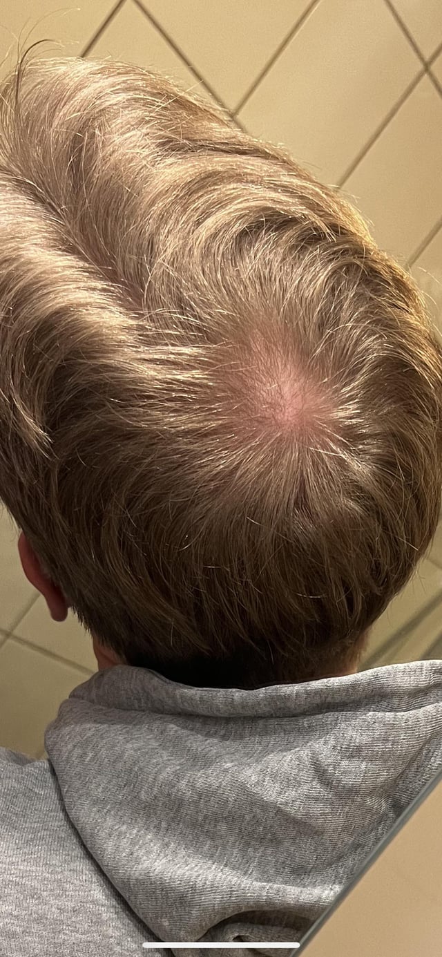 cowlick or balding