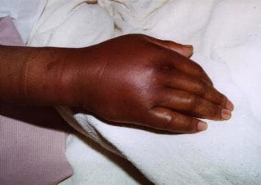 cellulitis of left hand icd 10