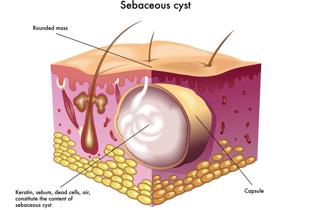 pilar cyst diagram