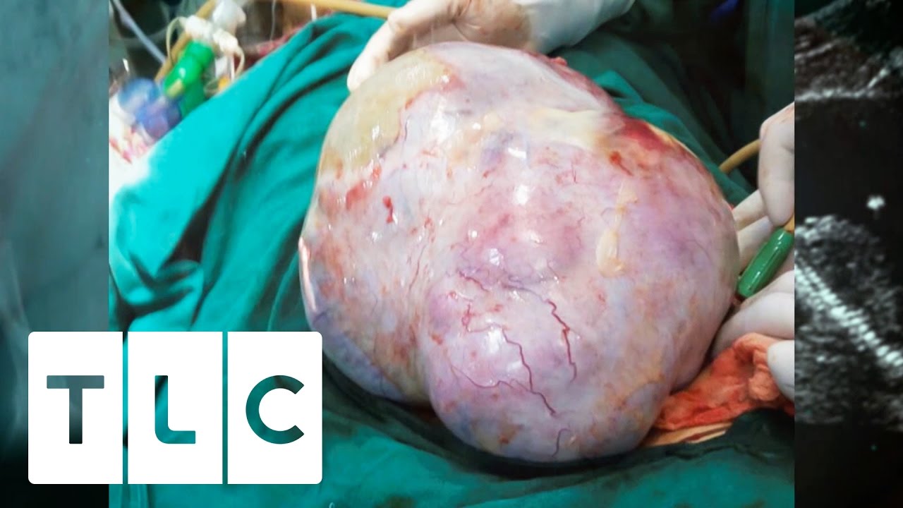 biggest cyst explosion ever seen