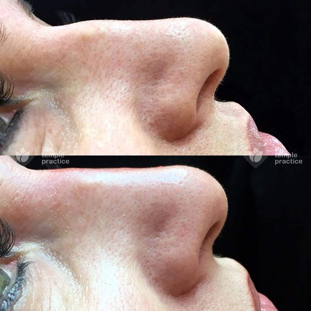 non surgical rhinoplasty leeds