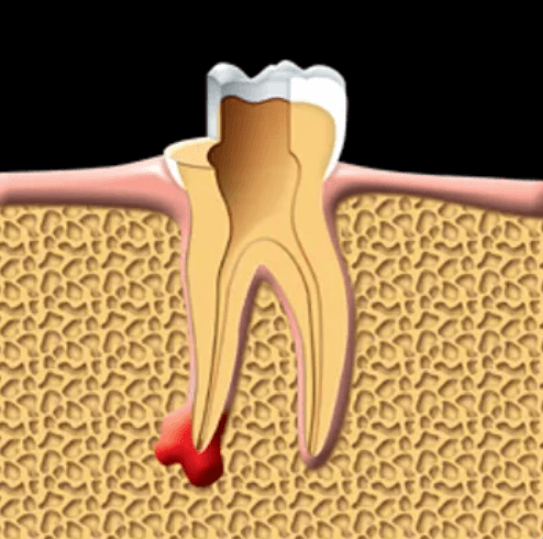 dental root canals services maple ridge