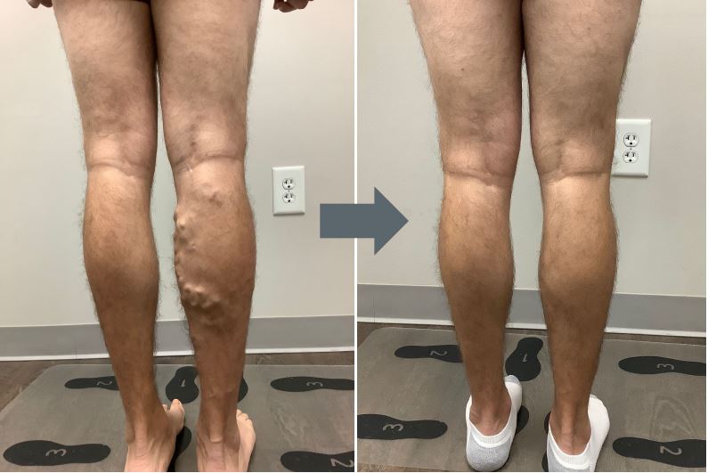 varicose veins peachtree city