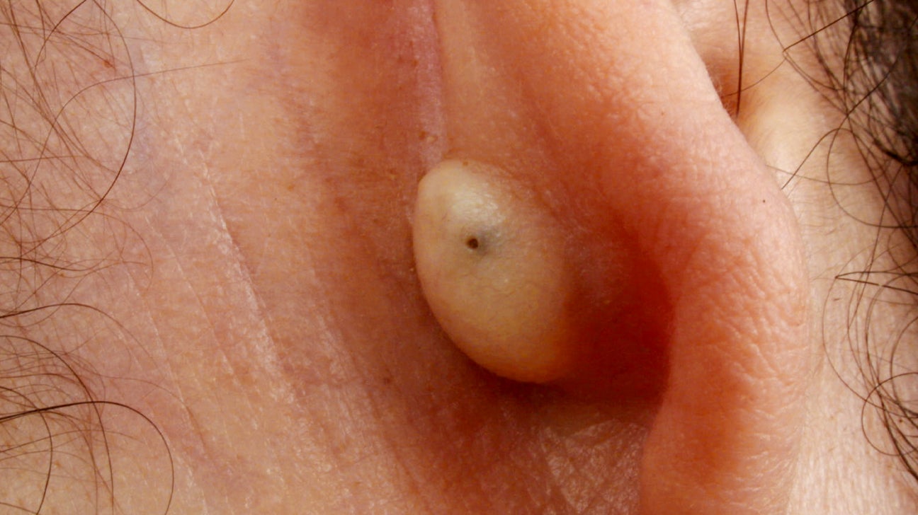 behind ear zit