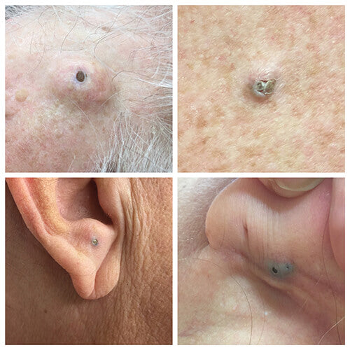 big blackheads