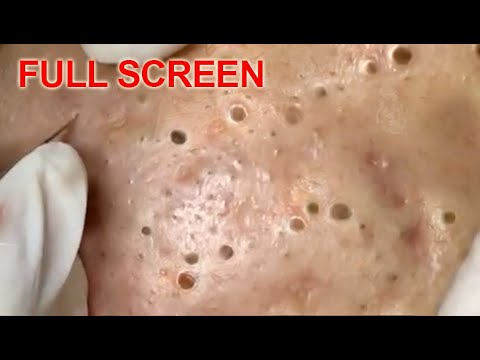 blackheads removal videos 2021