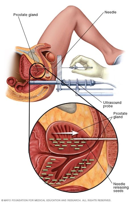 prostate massage therapy mayo clinic