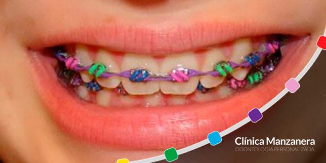 imagenes de brackets bonitos