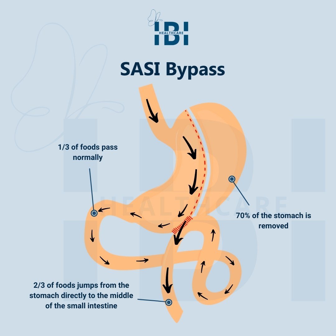 mini gastric bypass forum