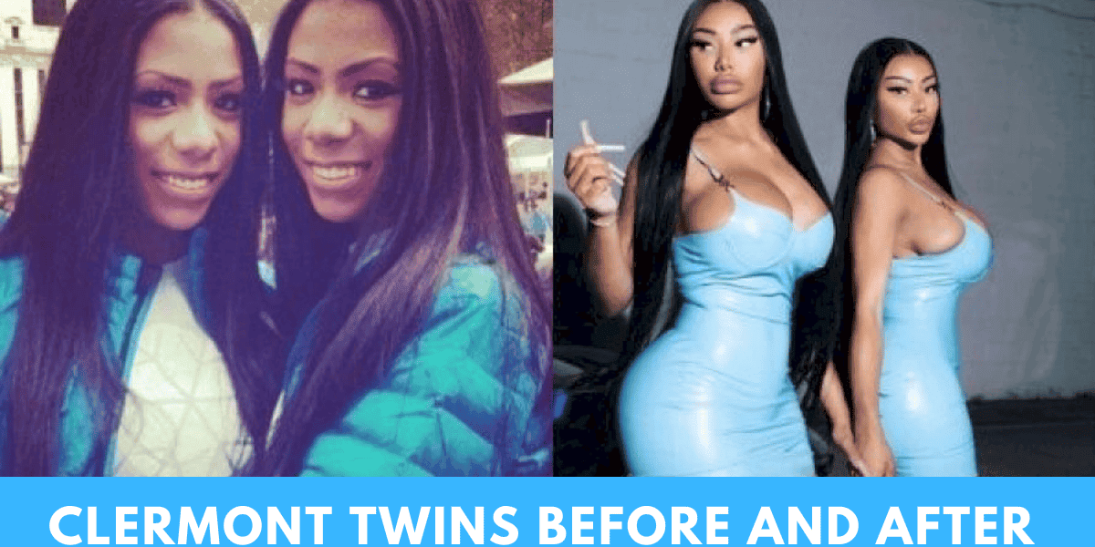 clermont twins before and after surgery