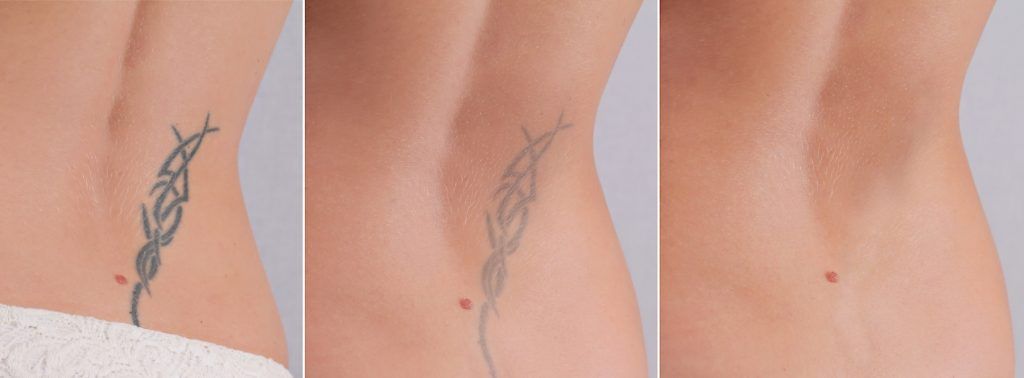 clinica para borrar tatuajes en los olivos