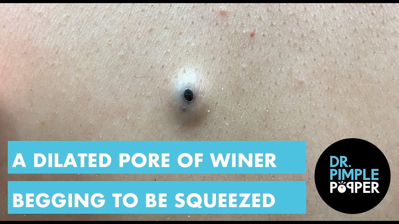 dilated pore of winer